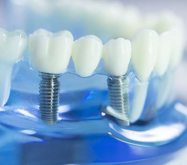 Bellflower Dental Implants