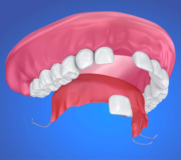 Bellflower Partial Denture for One Missing Tooth